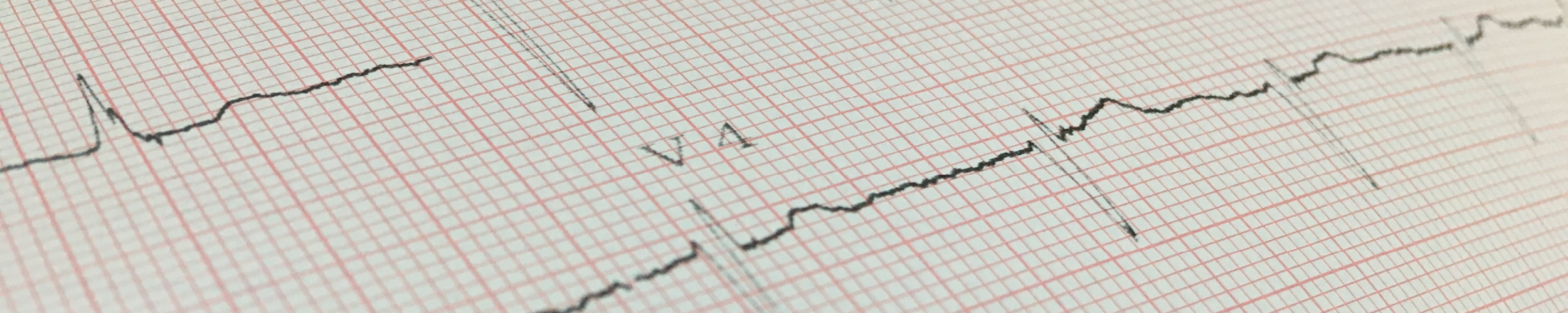Causes, symptoms and tests for Atrial Fibrillation
